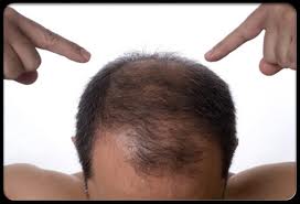 boy hair loss